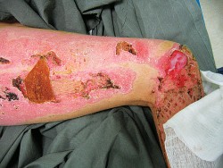 Пациентка К. Термические ожоги. После хирургического лечения. Ожоговая поверхность в области колена заклеена фибриновым клеем